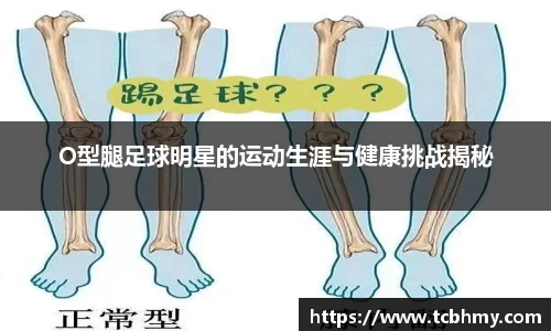 O型腿足球明星的运动生涯与健康挑战揭秘